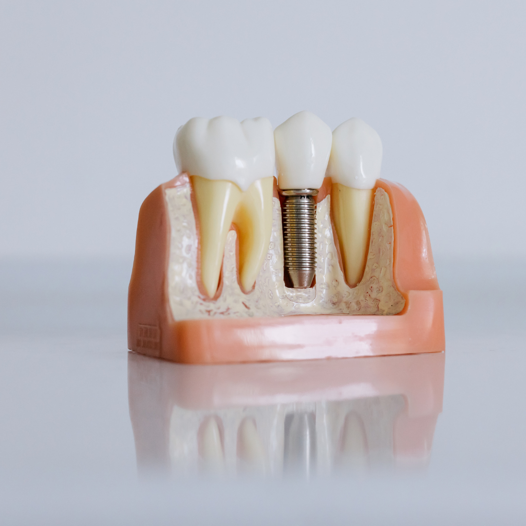 Implant (1) Implant Dentistry