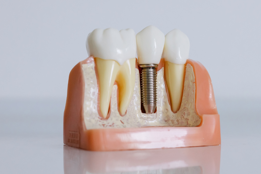 Untitled design (61) Implant Dentistry