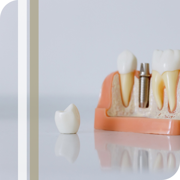 M314450 - Page Build Images Dental implants