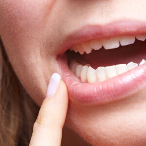 Close-up of a person's mouth and teeth, with a finger pointing near a slightly chipped front tooth.